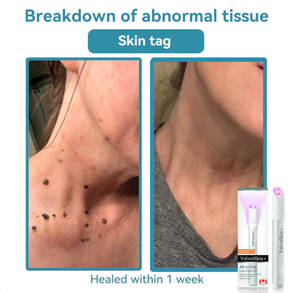 ☂DedMuller® VelvetSkin+Series ⚔️All-in-One Laser Eraser Pen🖊️ (🔬Powered by CO₂ laser technology – effectively removes moles, warts, skin tags, pigmentation spots, and other skin imperfections)