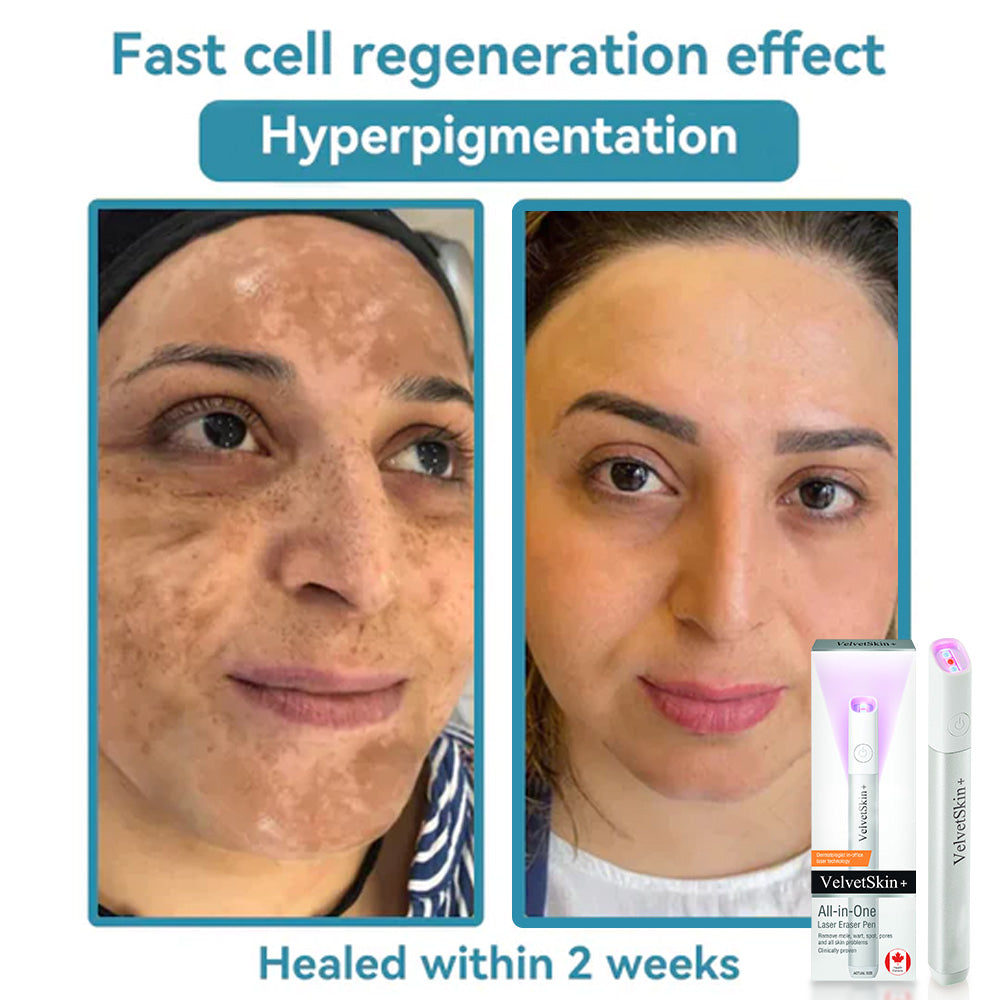 ☂DedMuller® VelvetSkin+Series ⚔️All-in-One Laser Eraser Pen🖊️ (🔬Powered by CO₂ laser technology – effectively removes moles, warts, skin tags, pigmentation spots, and other skin imperfections)
