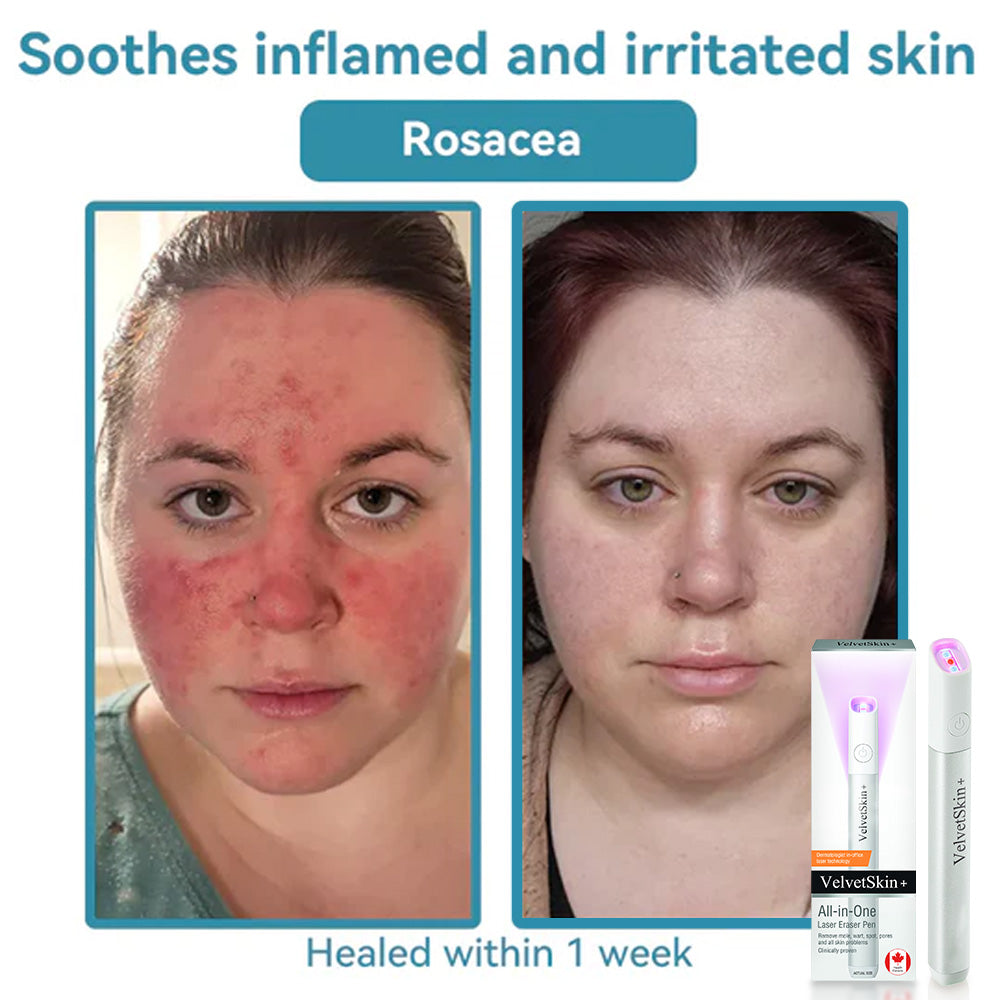 ☂DedMuller® VelvetSkin+Series ⚔️All-in-One Laser Eraser Pen🖊️ (🔬Powered by CO₂ laser technology – effectively removes moles, warts, skin tags, pigmentation spots, and other skin imperfections)