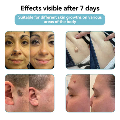 ☂DedMuller® VelvetSkin+Series ⚔️All-in-One Laser Eraser Pen🖊️ (🔬Powered by CO₂ laser technology – effectively removes moles, warts, skin tags, pigmentation spots, and other skin imperfections)